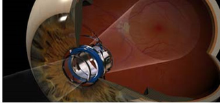 Illustration for article titled Tiny 4mm Telephoto Lens Implant Is One Step Closer To Being in Your Eye